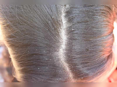 Hair Oiling Side Effects: খুশকি তাড়াতে গিয়ে করলে এই ভুল কাজ, চুল উঠে পড়বে টাক!
