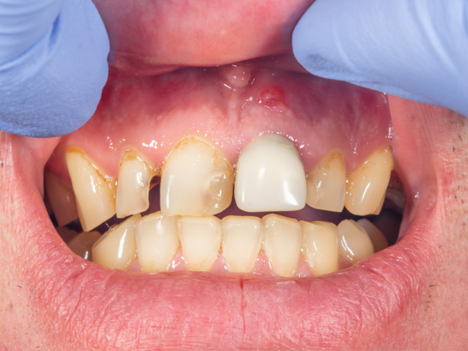 yellow teeth oral health tips