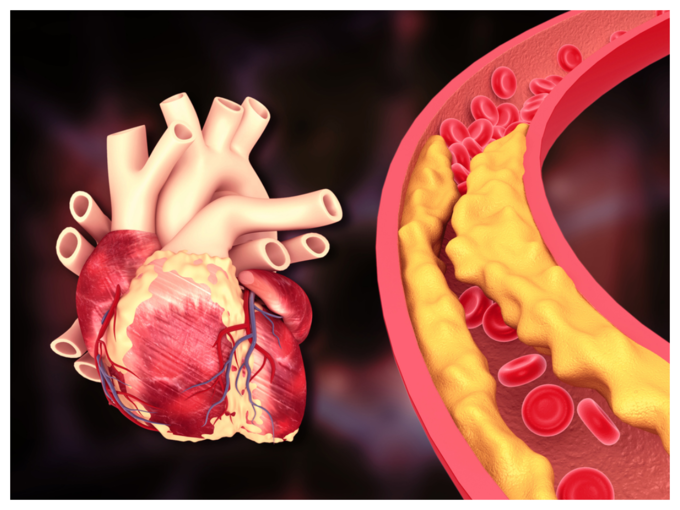 ಕೊಲೆಸ್ಟ್ರಾಲ್ ನಿರ್ವಹಣೆ ಏಕೆ ಮುಖ್ಯ?