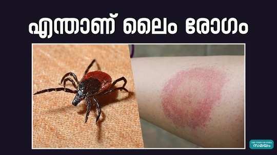 lyme disease symptoms treatment and prevention