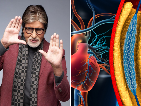 अमिताभ बच्चन के दिल की हुई सर्जरी? नसों की ब्लॉकेज खोलती है एंजियोप्लास्टी, हार्ट अटैक से बचाने का उपाय 