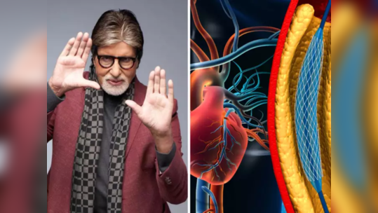 Amitabh Bachchan ची हृदयविकाराच्या झटक्यामुळे सर्जरी? नसातील ब्लॉकेज खोलते अँजिओप्लास्टी, वाचा अटॅक रोखणारे उपाय 