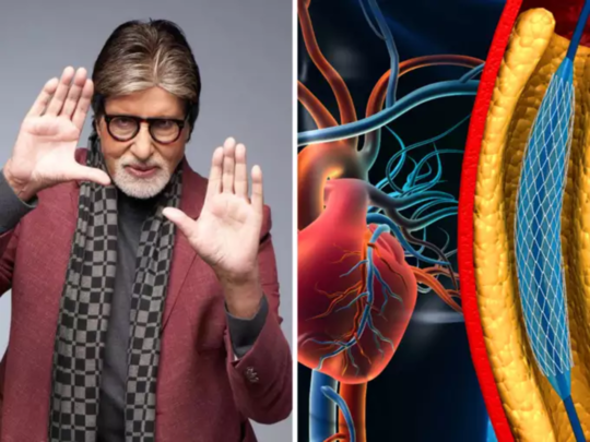 Amitabh Bachchan ची हृदयविकाराच्या झटक्यामुळे सर्जरी? नसातील ब्लॉकेज खोलते अँजिओप्लास्टी, वाचा अटॅक रोखणारे उपाय 