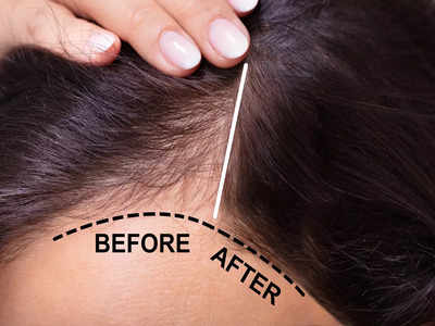 DIY Hair Regrowth Tonic: গোলাপ-জবার এই হেয়ার টনিক লাগান স্ক্যাল্পে, তাহলেই নতুন চুল গজাবে টাকে!