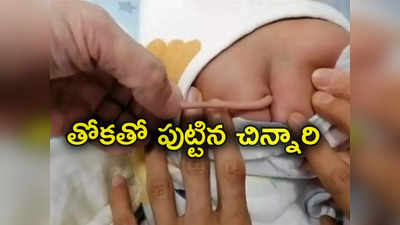 Baby Birth With Tail: విచిత్రం.. తోకతో పుట్టిన చిన్నారి.. ఆశ్చర్యంలో మునిగిపోయిన డాక్టర్లు