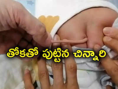 Baby Birth With Tail: విచిత్రం.. తోకతో పుట్టిన చిన్నారి.. ఆశ్చర్యంలో మునిగిపోయిన డాక్టర్లు