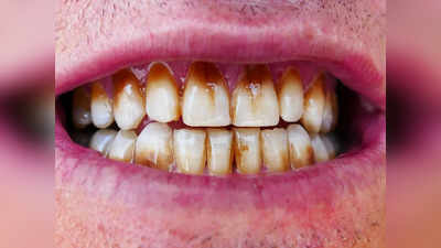 How to Whiten Yellow Teeth: 2 बार ब्रश करने से भी नहीं हट रही दांतों की पीली गंदगी? 5 नुस्खे चमकाएंगे बत्तीसी