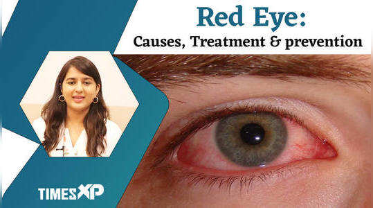 what are the causes of red eyes insights from expert watch video
