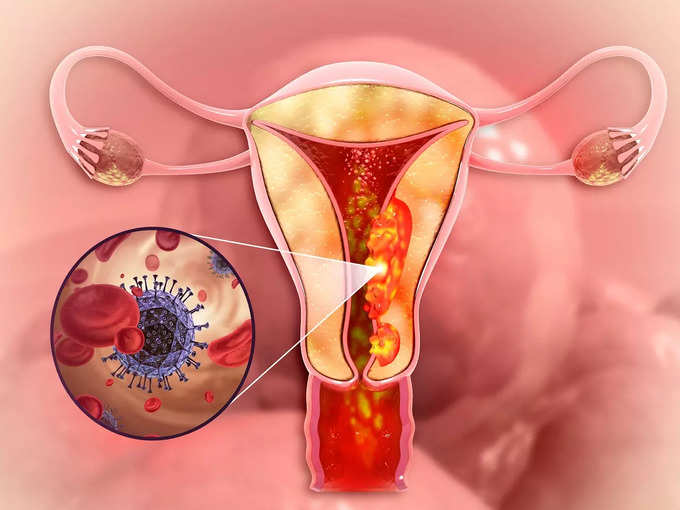 ​கர்ப்பப்பை புற்றுநோய் what is ovarian cancer என்றால் என்ன?​
