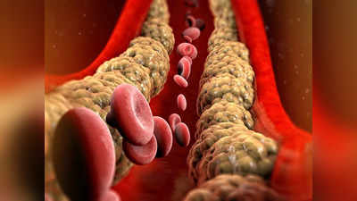 Signs of Cholesterol in Men: पुरुषों में कोलेस्ट्रॉल बढ़ने के 5 लक्षण, पीला जहर निकालेंगे 5 घरेलू उपाय