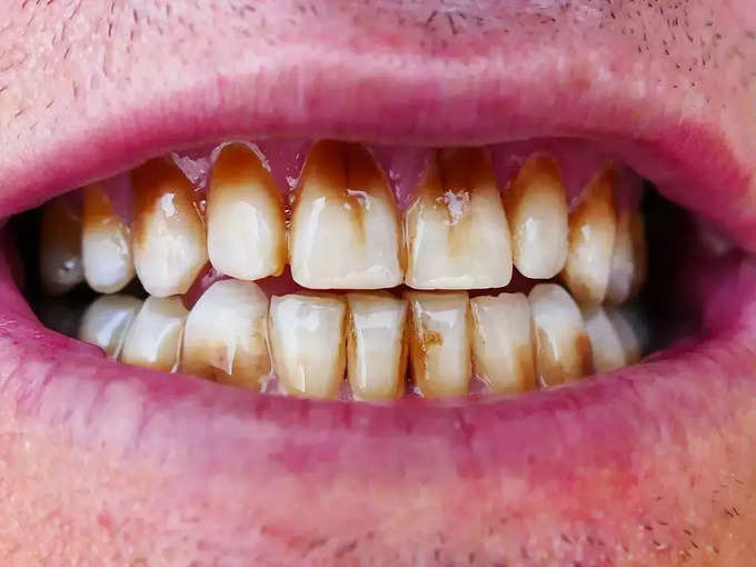 दांतों की सड़न का इलाज है एलोवेरा