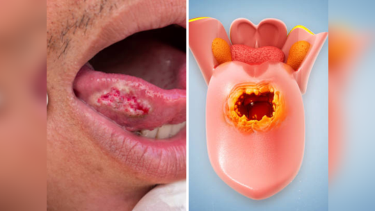 Mouth Cancer चे पहिल्याच स्टेजवर होईल निदान, IIT Kanpur मध्ये तयार करण्यात आला खास टूथब्रश
