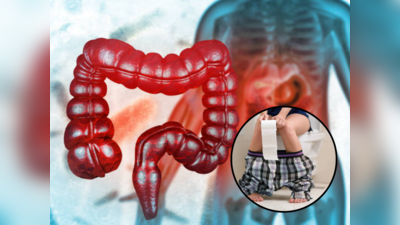 Remedies For Colitis: पोटदुखी,सतत शौचाला धावताय? आतड्यामध्ये सडलेली घाण, सूज काढण्यासाठी वापरा हे ५ घरगुती उपाय