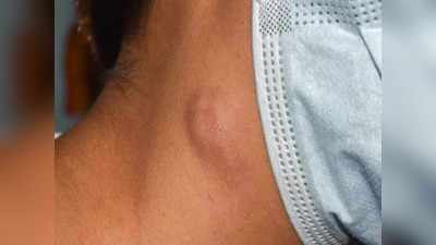 Lymph Node Swelling Signs: लिम्फ नोड्स में होने वाली सूजन को न करें अनदेखा, इन लक्षणों पर नजर बनाए रखें
