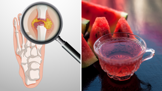 Drinks for Uric Acid: गर्मी में जरूर पिएं ये 5 ड्रिंक्स, पेशाब के रास्ते बह जाएंगे यूरिक एसिड के कंकड़