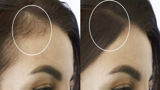 Hair Thinning: পাতলা চুল কি আবার ঘন হওয়া সম্ভব? সত্য-মিথ্যা খোলসা করলেন চিকিৎসক
