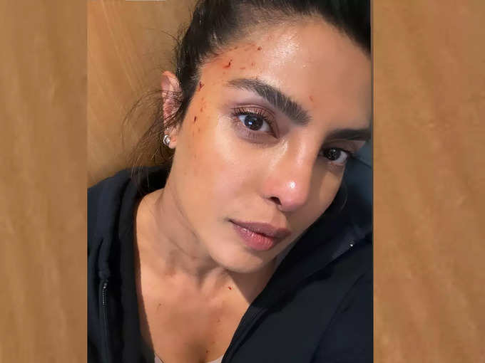 priyanka-injury