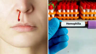 ​World Hemophilia Day: बिना किसी कारण के नाक से आता है खून? इस जानलेवा बीमारी की गिरफ्त में हो सकते हैं आप​