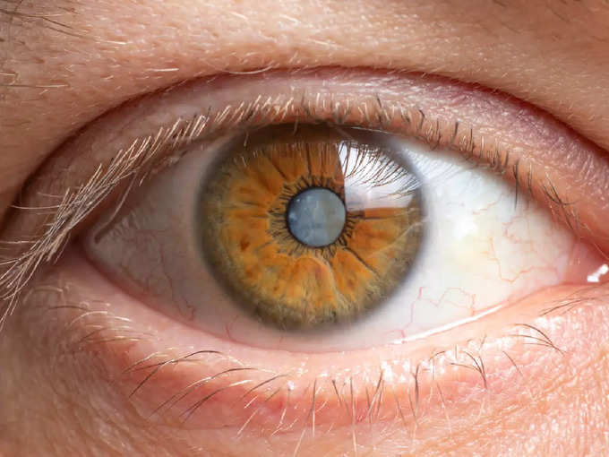cataract glaucoma