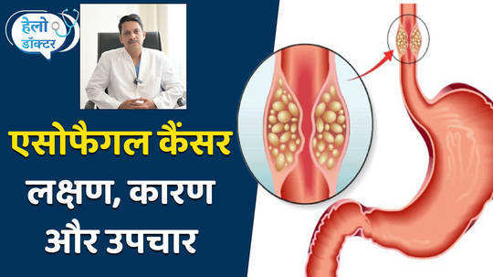 what is esophageal cancer know symptoms risk factors and treatment from experts