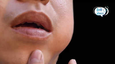 Mumps Outbreak: फिर तेजी से फैल रहा गलसुआ, गुब्बारे की तरह सूज रहे गाल, ये 5 लक्षण दिखते ही अस्पताल भागें