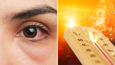 Summer Eye Care Tips: गर्मियों में आंखों का लाल होना, पानी आना, दर्द और जलन से राहत देंगे Dr. के 5 उपाय