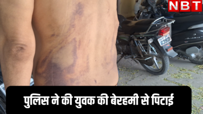 धौलपुर में पुलिस पर लगे गंभीर आरोप, युवक की इतनी पिटाई कि चमड़ी उधड़ गई, SP ने बैठाई जांच