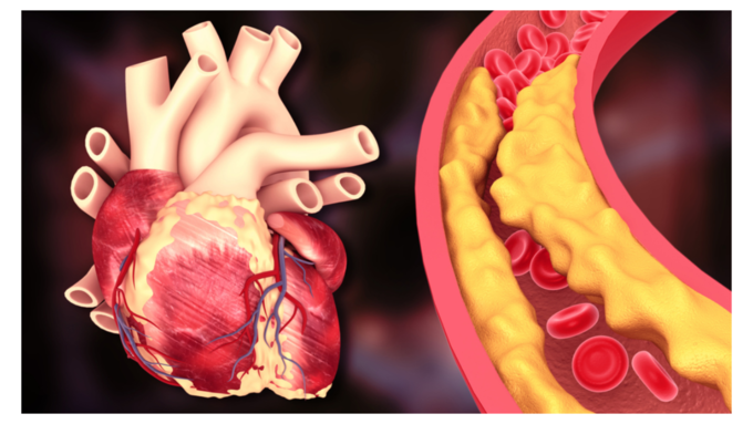 ಕೊಲೆಸ್ಟ್ರಾಲ್ ಮಟ್ಟವನ್ನು ನಿಯಂತ್ರಿಸುವುದು ಏಕೆ ಮುಖ್ಯ?