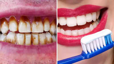 स्मोकिंग के कारण पीले दांतों की सफाई करेंगे ये 6 घरेलू उपचार, मोती से चमकेगी बत्तीसी