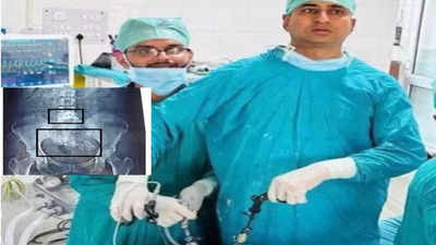 महिला के पेट में 40 पत्थर... डॉक्टरों ने 4 फीट आंत काट कर निकाले; जयपुर के SMS अस्पताल का कमाल