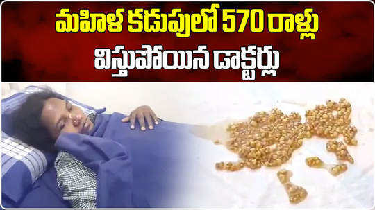 doctors removed 570 stones from woman stomach after rare surgery in amalapuram