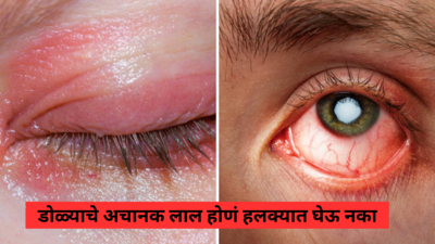 Summer Eye Care Tips: डोळ्याचे लाल होणं हलक्यात घेऊ नका, या गोष्टी नक्की करून पाहा