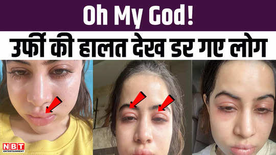 uorfi javed shared her photos of swollen face due to allergies watch video