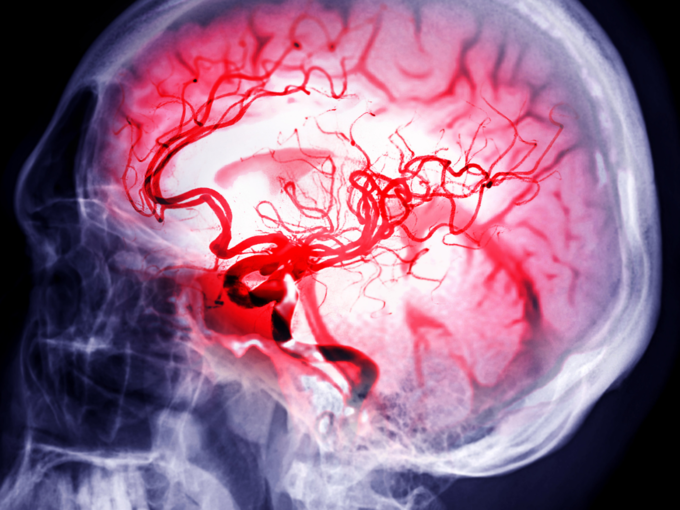 brain bleeding skull brain stroke hemorrhage