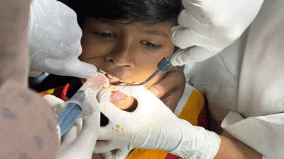 बच्चे के गले में फंसा टूथब्रश, फिर डॉक्टर्स ने सर्जरी कर यूं बचाई जान