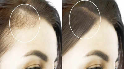 Thin Hair Partition: অল্প বয়সেই মাথায় টাক? কী ভাবে সিঁথি করলে ঘন দেখাবে চুল? ঝটপট জানুন