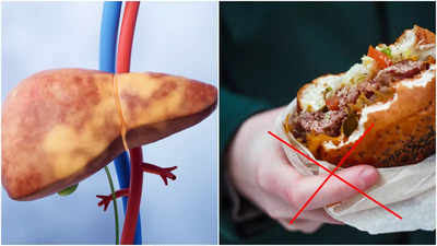 Diet for Fatty Liver: ভোগাচ্ছে ফ্যাটি লিভার? এসব খাবার ছুঁতেও বারণ করলেন চিকিৎসক