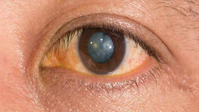 How To Prevent Cataract: शुरू होने से पहले ही मोतियाबिंद की जड़ काट देंगे 6 आयुर्वेदिक तरीके, नजर होगी तेज़