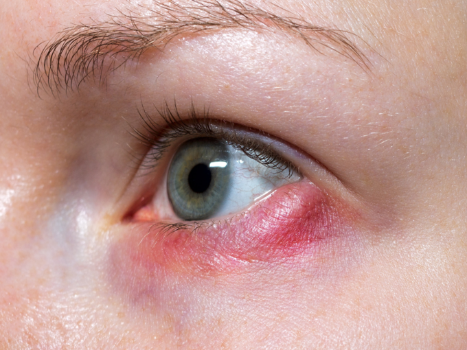 eye flu eye infection swelling