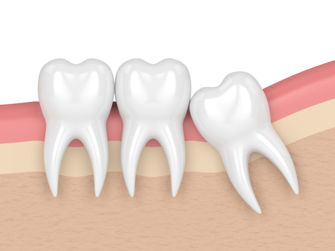 dental oral health widom teeth toothache (6)