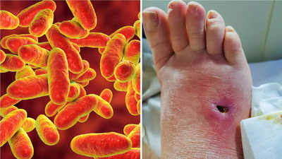 Japan Virus Outbreak: अजीब है ये बैक्टीरिया, अंदर ही अंदर चट कर रहा लोगों का मांस, अब तक 77 की मौत, 5 लक्षणों पर रखें कड़ी नजर