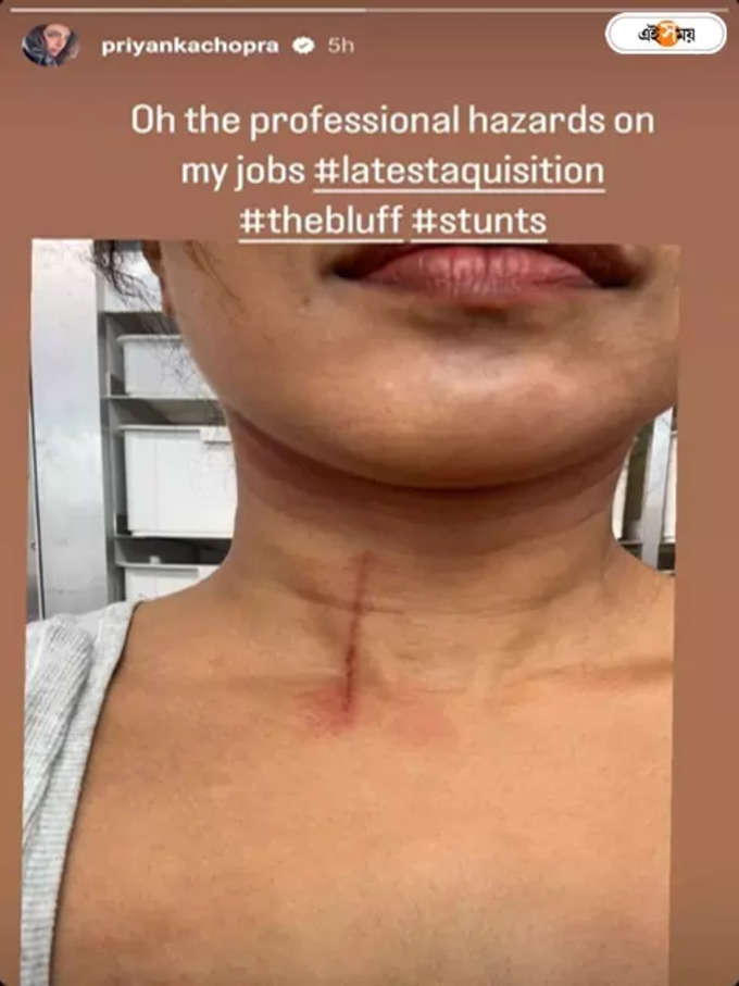 Priyanka Chopra injured