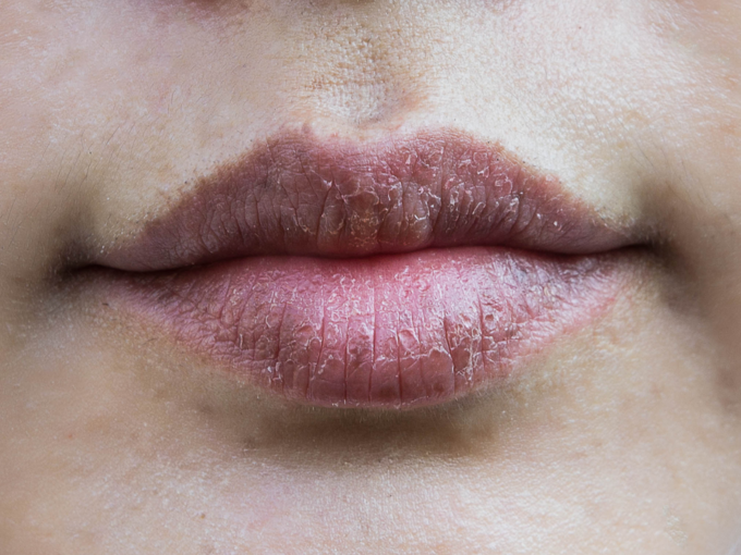 cracked dry lips (2)