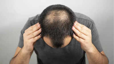 Men Baldness: অকালে মাথা জুড়ে পড়েছে টাক? পুরুষেরা কারণ জেনে ব্যবস্থা নিন তড়িঘড়ি