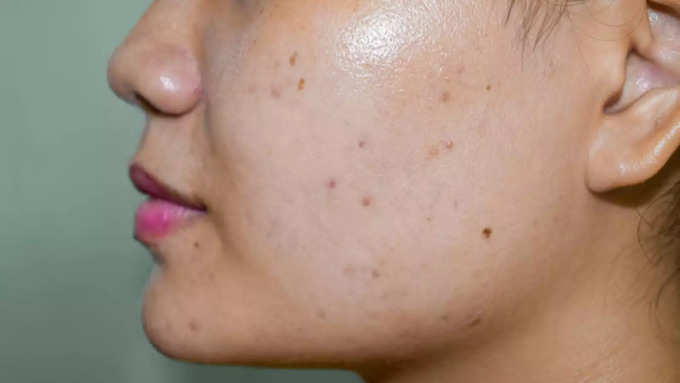 Melasma का असर कहां-कहां?