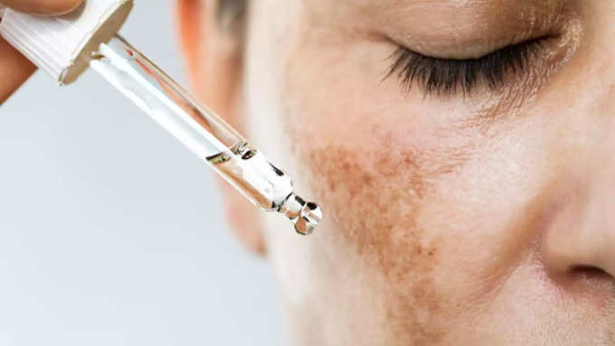 Melasma आखिर है क्या?