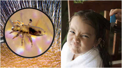 Anti-Lice Treatment: সন্তানের মাথায় বাসা বেঁধেছে উকুন? দূর করতে ৪ ঘরোয়া টোটকা কাজে লাগান