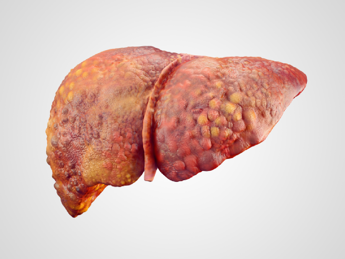 fatty liver