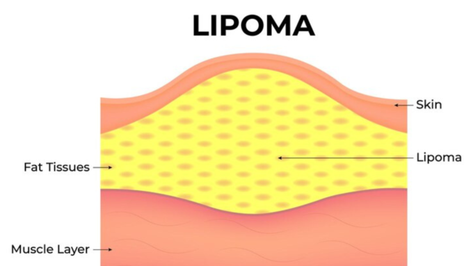 क्या है लिपोमा? 