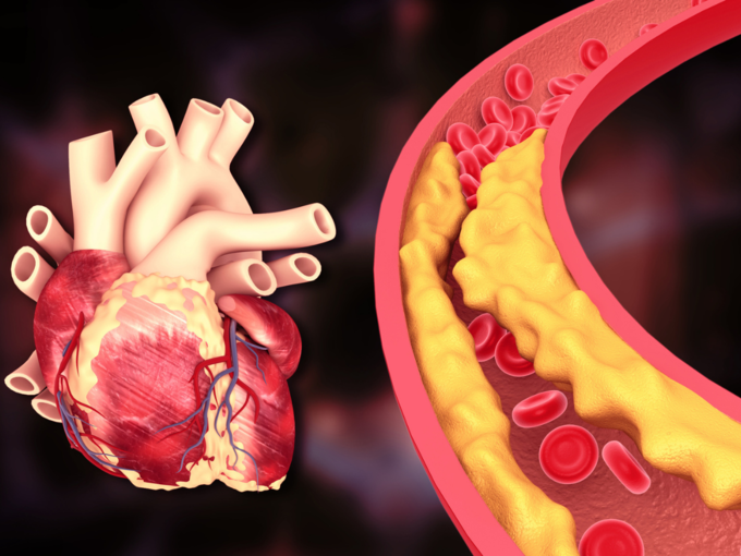 high cholesterol in heart artery